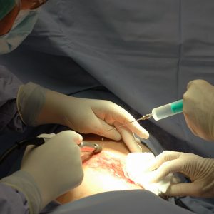 Ambulatory Phlebectomy
