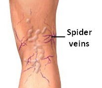 spider_veins_img