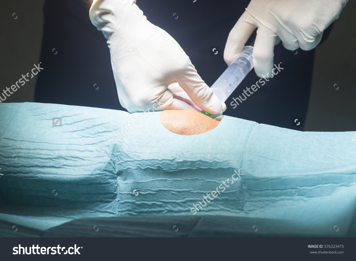 stock-photo-anaesthtist-anaesthetic-injection-in-knee-for-surgery-hospital-operation-medical-procedure-in-576323473
